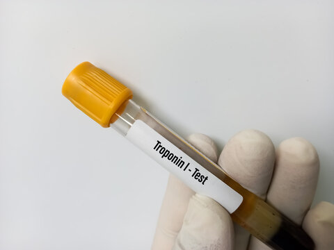 Blood sample for Troponin-I test, diagnosis for cardiovascular disease. myocardial infarction