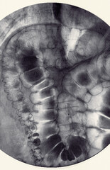 X-ray examination of the large intestine (colon). Barium enema, double contrast analysis