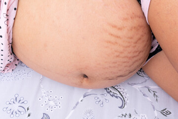 flat tummy with stretch marks from pregnancy