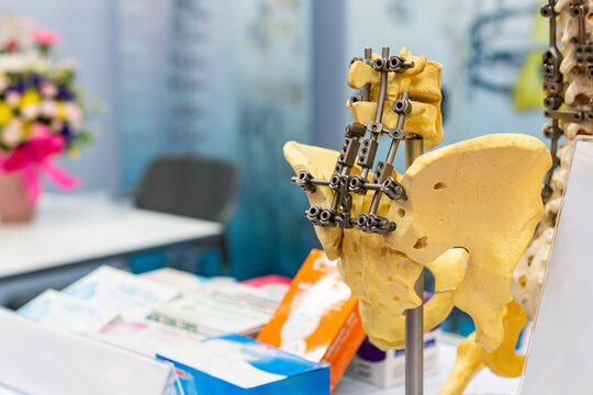 sample structure show hip bone and spine bone with metal fixation set on table