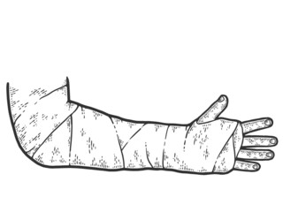 Broken arm, bone fracture, trauma, orthopedic plaster cast. Sketch scratch board imitation.