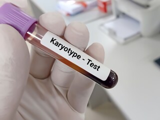 Biochemist or doctor holds blood sample for karyotype test, abnormal chromosome, to identify and evaluate the size, shape, and number of chromosomes.