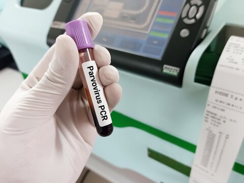 Biochemist or doctor holds blood sample for Parvovirus PCR test. Medical test tube in laboratory background.