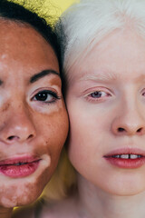 Group of multiethnic women with different kind of skin posing together in studio. Concept about body positivity and self acceptance