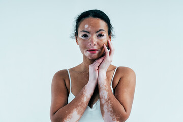 Beautiful woman with vitiligo skin posing in studio. Concept about body positivity and self...