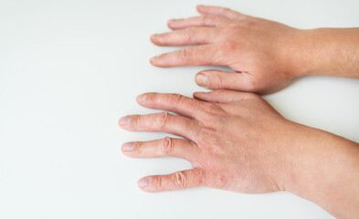 Treating skin diseases. Psoriasis, eczema, dermatitis, diathesis, on human hands. The concept of medicine and treatment in the direction of dermatology.