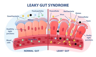 Leaky gut Syndrome concept. Comparison of healthy organ and inflamed tissue cells. Diseases of gastrointestinal tract. Toxins and viruses. Cartoon flat vector illustration isolated on white background - obrazy, fototapety, plakaty
