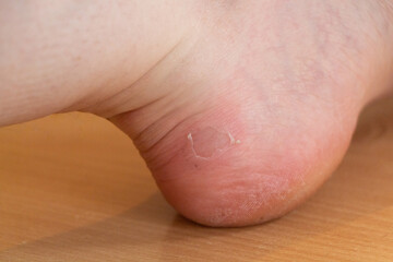 Naklejka premium Wound after a blister on the foot