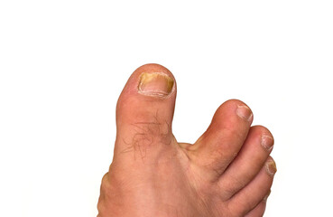 Onychomycosis is a fungal infection of the nail. Mycosis of the foot. Foot with affected nails on a...