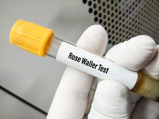 Blood sample for rose waller test, haemagglutination slide test, detection of IgM Rheumatoid Factor