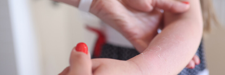 Doctor examining hand of little girl with sunburn closeup