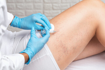 Removal of varicose veins on the legs. Medical inspection and treatment of Telangiectasia....