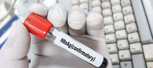 Blood sample for HBsAg(hepatitis B virus surface Antigen) confirmatory test. medical and health concept