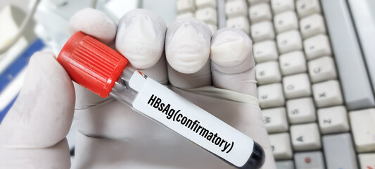 Blood sample for HBsAg(hepatitis B virus surface Antigen) confirmatory test. medical and health...