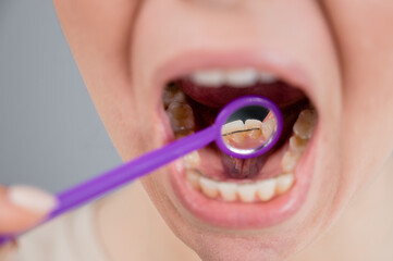 Close-up portrait of a woman with internal braces and a dental mirror. The girl corrects the bite