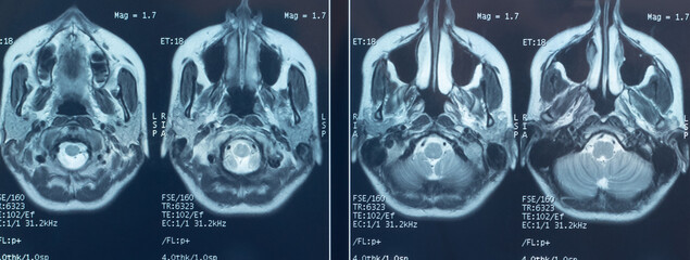 Close-up photo of an MRI of the skull and brain of a person with severe headaches; magnetic and nuclear resonance as a diagnostic method in neurology