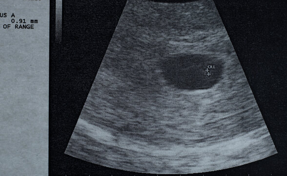 Ultrasound image of the embryo without heartbeat, stopped evolving at 6 weeks