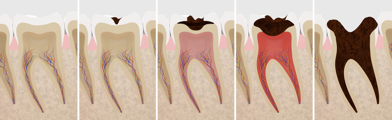 虫歯の進行度の断面の3Dレンダリング - obrazy, fototapety, plakaty