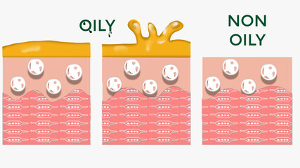 OILY SKIN ILLUSTRATION FOR PIMPLE-PRONE SKIN, VS NORMAL SKIN