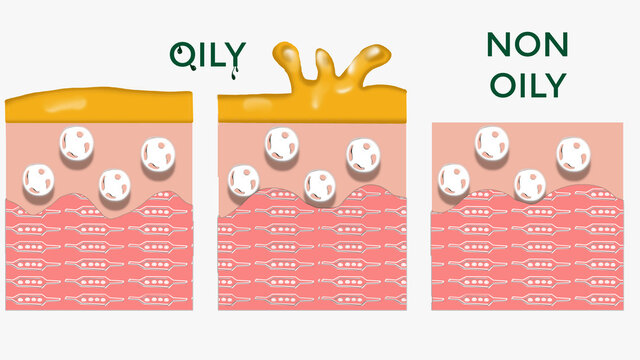 OILY SKIN ILLUSTRATION FOR PIMPLE-PRONE SKIN, VS NORMAL SKIN