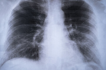 Chest x-ray, coronavirus pandemic lung