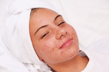 Fototapeta na wymiar Acne. A smiling teenage girl with pimples on her face. Facial skin care.