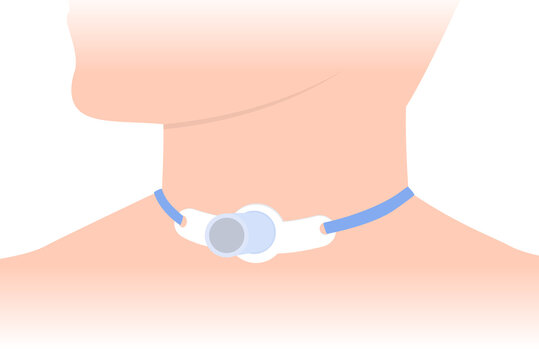 Tracheostomy tube at the patient neck who can not breathe with nose and mouth. Illustration about people has a Health Issues. Closeup.