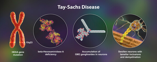 Tay-Sachs disease, 3D illustration