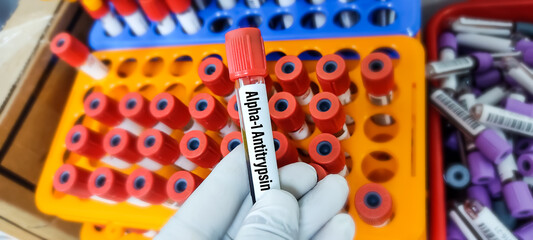 Scientist holds a blood sample tube for Alpha 1 antitrypsin(A1AT) Test. alpha-1 antitrypsin...