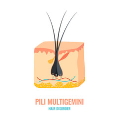 Pili multigemini hair disorder surface under microscope. Multiple hair shafts ingrowth condition closeup vector. Trichology medical concept.