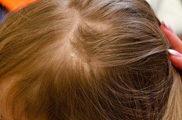 Dermatitis of the skin on the baby's head