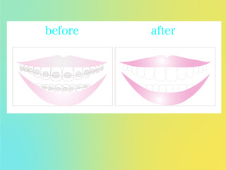 歯科矯正のビフォーアフターイラスト