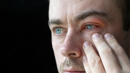 Close Up of Man Touch His Severe Bloodshot Red Blood Eye Affected by Conjunctivitis or After...