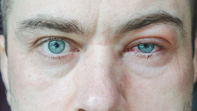 Close Up of Severe Bloodshot Red Blood Eye of Male Affected by Conjunctivitis or After Allergy. Man with Viral Blepharitis, Conjunctivitis, Adenoviruses. Irritated, Infected Eye or Insect Bite