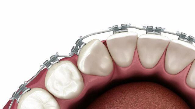 Cuspid correction with braces. Medically accurate dental 3D illustration