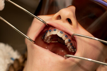 Mouth opened with dental retractors to show metal braces and teeth palatal expander. Orthodontic...