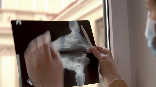 Doctor examines x-ray film of broken foot