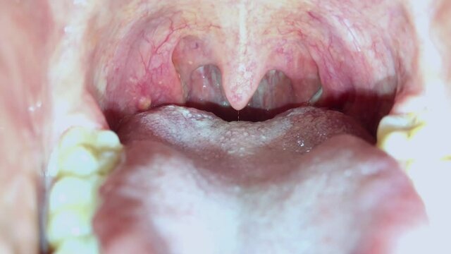 Close up to the inside of the human mouth. ENT medicine. Angina, tonsillitis, pharyngitis, a cold, flu, illness, health, diagnosis.