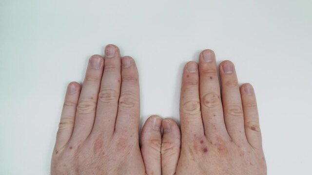Painful rash, red blisters on a man's arm. Human hands with dermatitis, allergy rash. Enterovirus. Coxsackie virus. Allergic rash on the hands of an adult man