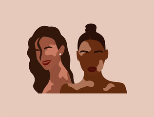 Two women with vitiligo of different nationalities together.Abstract faceless potrait of female. Pigmentation dermatology disease concept. Modern flat vector illustration