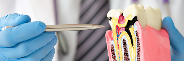 Dentist doctor showing with pen caries on dummy tooth closeup