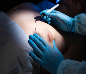 Doctor plastic surgeon makes marks with a felt-tip pen for plastic surgery to correct male breast,...