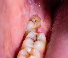 Impacted wisdom tooth due to which a gum hood was formed. Inflammation of the gums due to an...