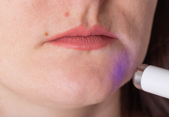 Treatment of wrinkles and problem skin on the face with a laser pen. Removing red acne, macro
