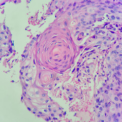 Camera photo of cervical carcinoma, showing keratin pearl, magnification 400x, photograph through a...