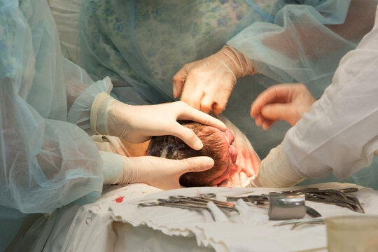 Baby being born via Caesarean section