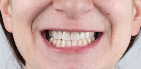 press ceramic crowns and veneers