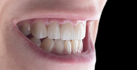 press ceramic crowns and veneers
