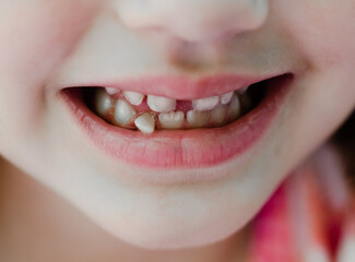 Young Child Smiling with Loose Tooth