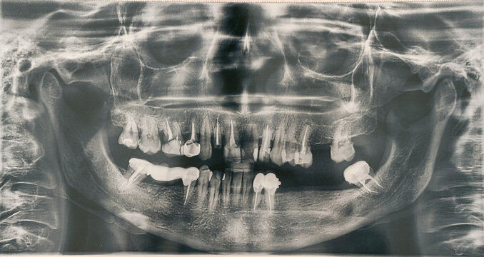 Panoramic X-ray of teeth. Dental treatment in dentistry. Female sick teeth.